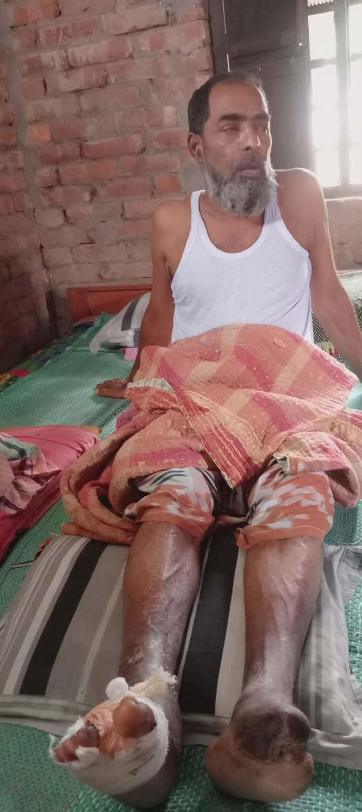 ডায়াবেটিসে দুই পা হারিয়ে অসহায় আব্দুস সালাম, চিকিৎসার জন্য সাহায্যের আবেদন